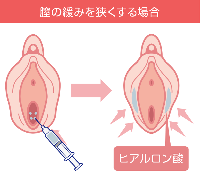 膣の緩みを狭くする場合の画像